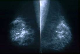 Mammogram